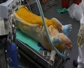 Pig Xenotransplantation